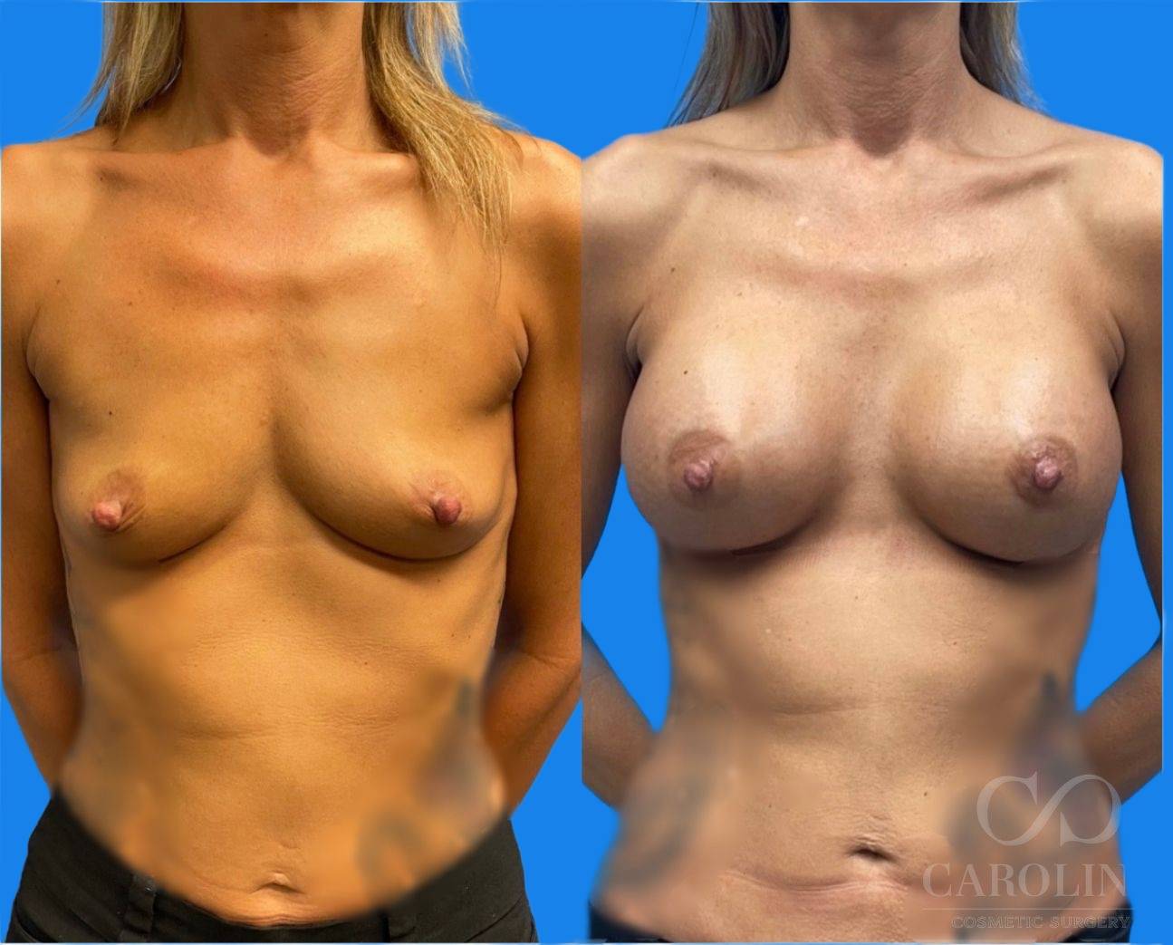 Case--4474 | Before and After Breast Augmentation