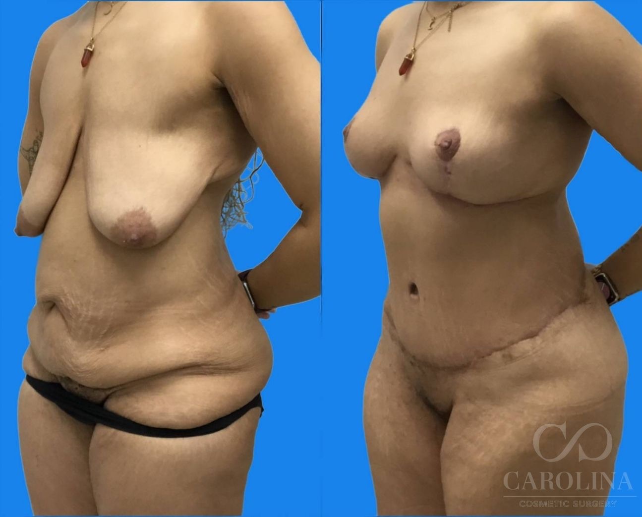Case--2093 | Before and After Breast Lift 2