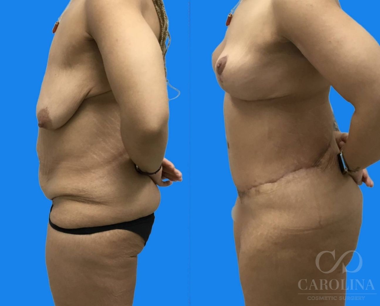 Case--2093 | Before and After Breast Lift 4