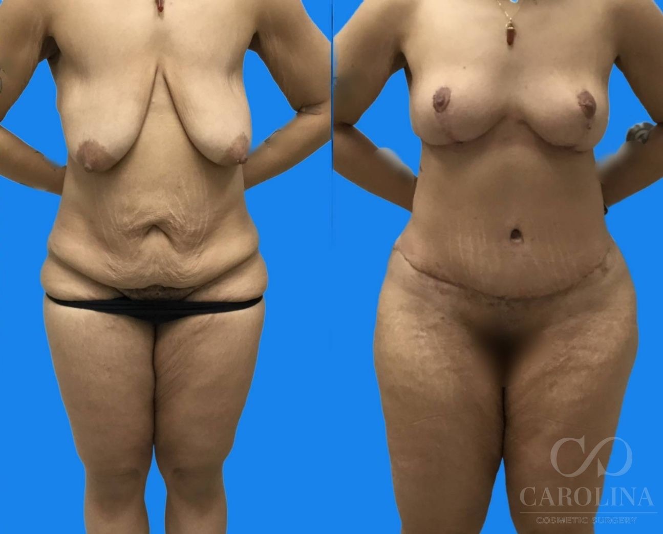 Case--2093 | Before and After Tummy Tuck