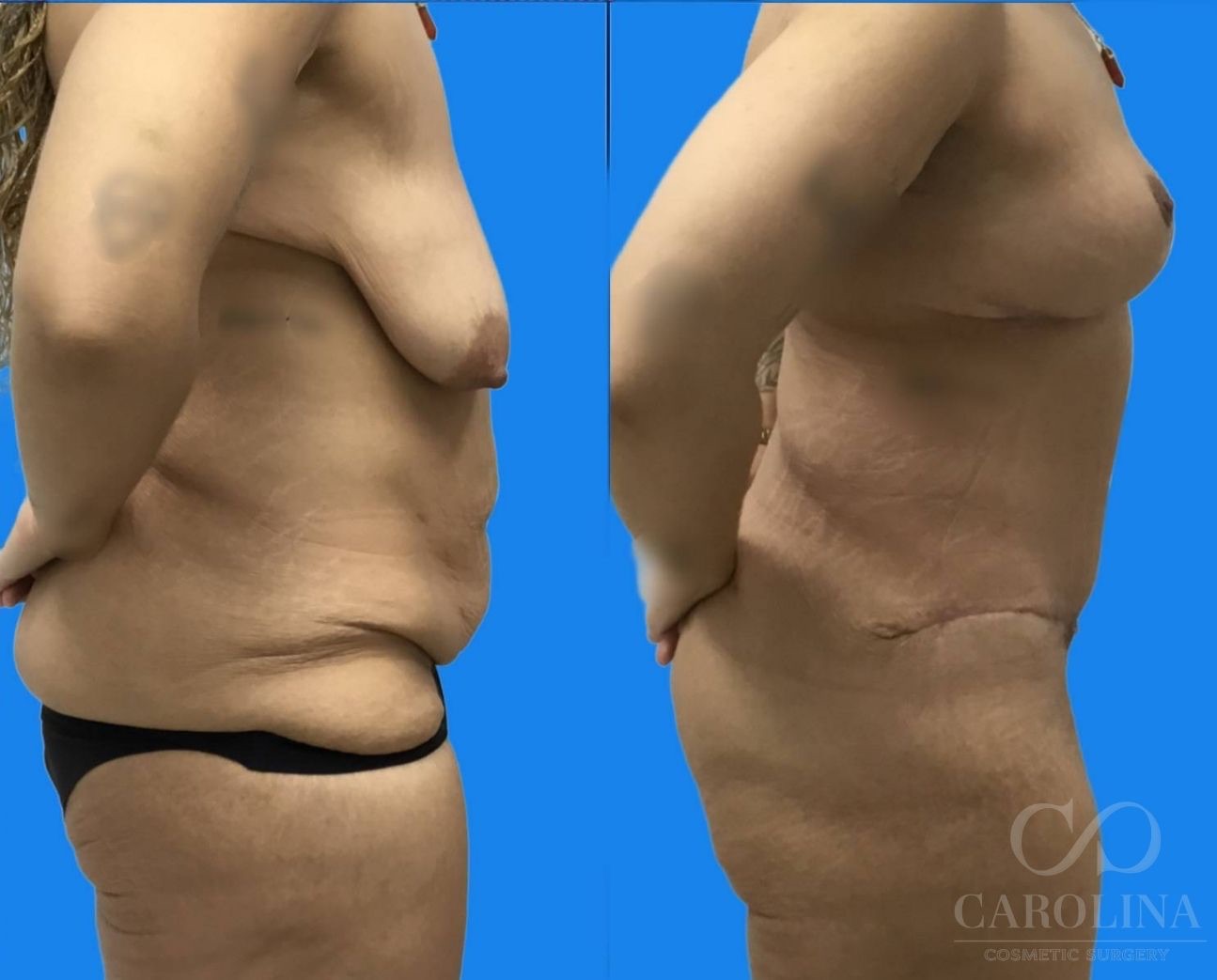 Case--2093 | Before and After Breast Lift 3