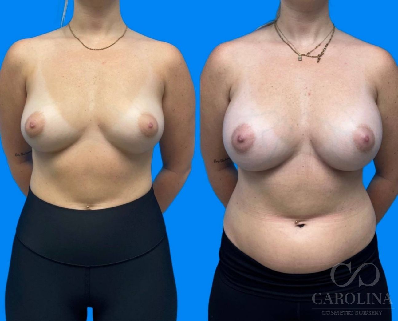 Case--5325 | Before and After Breast Augmentation 3