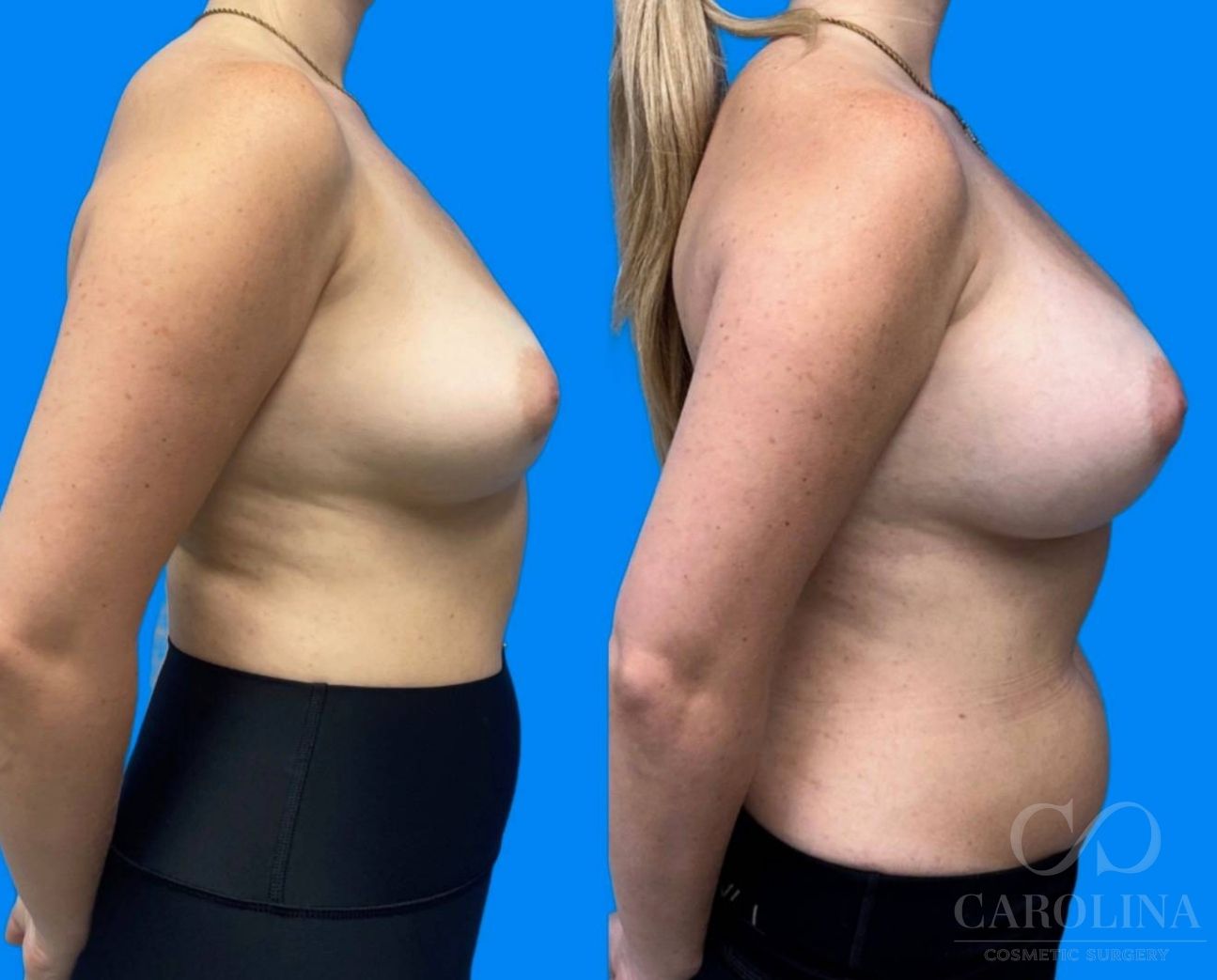 Case--5325 | Before and After Breast Augmentation 2