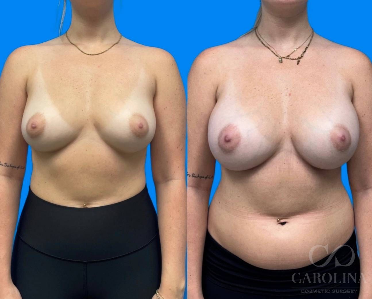 Case--5325 | Before and After Breast Augmentation