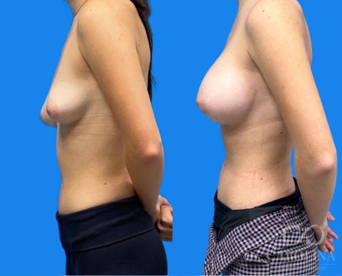 Case--8456 | Before and After Breast Augmentation 4