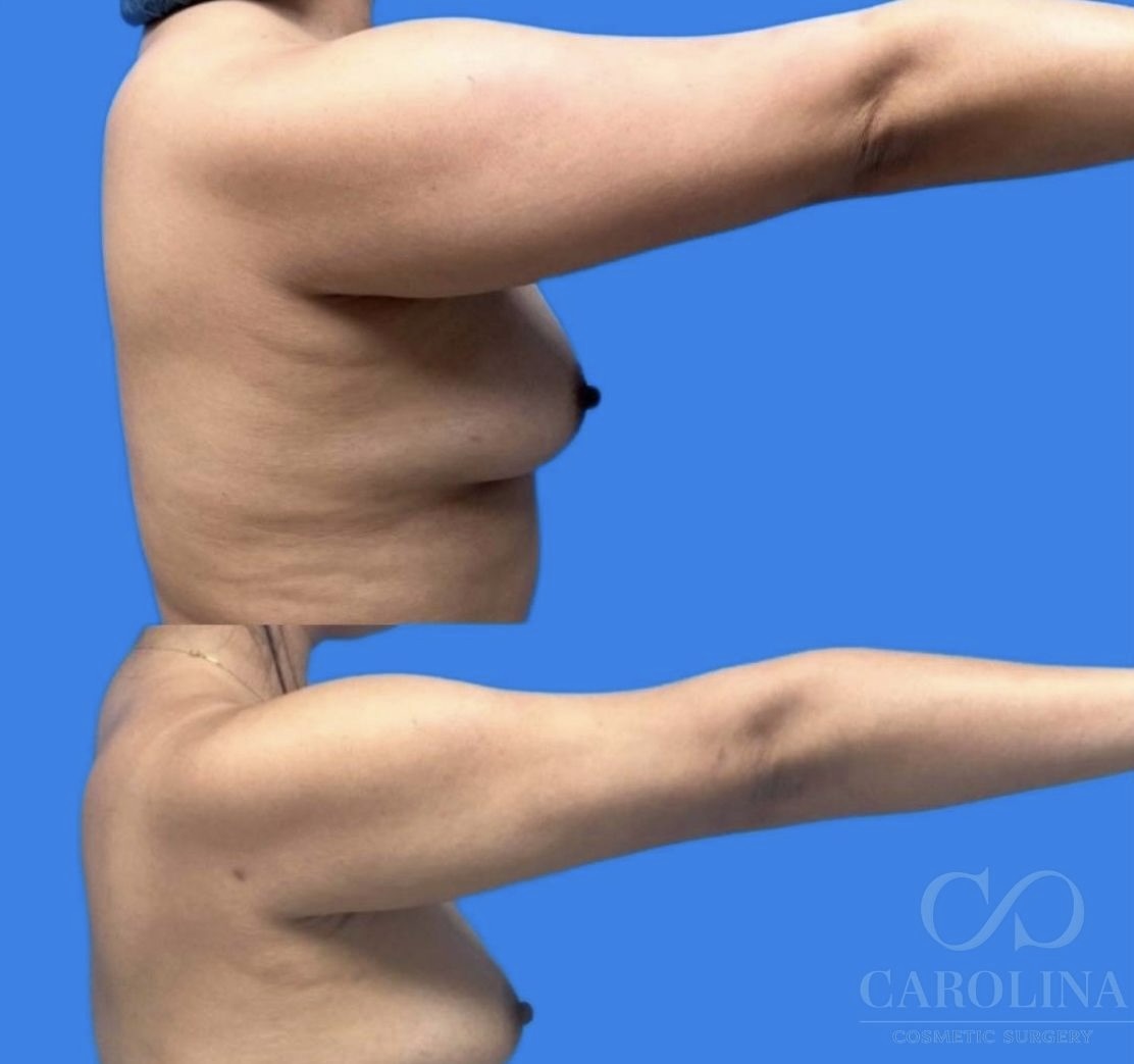 Case--6433 | Before and After Arm Sculpt 2