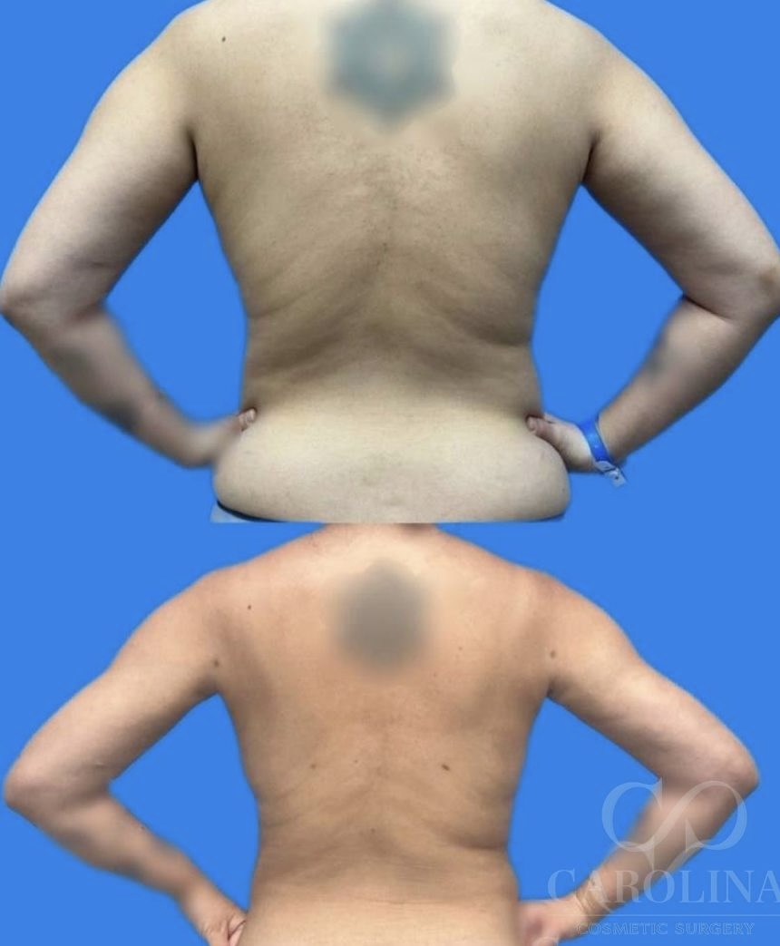 Case--6433 | Before and After Arm Sculpt