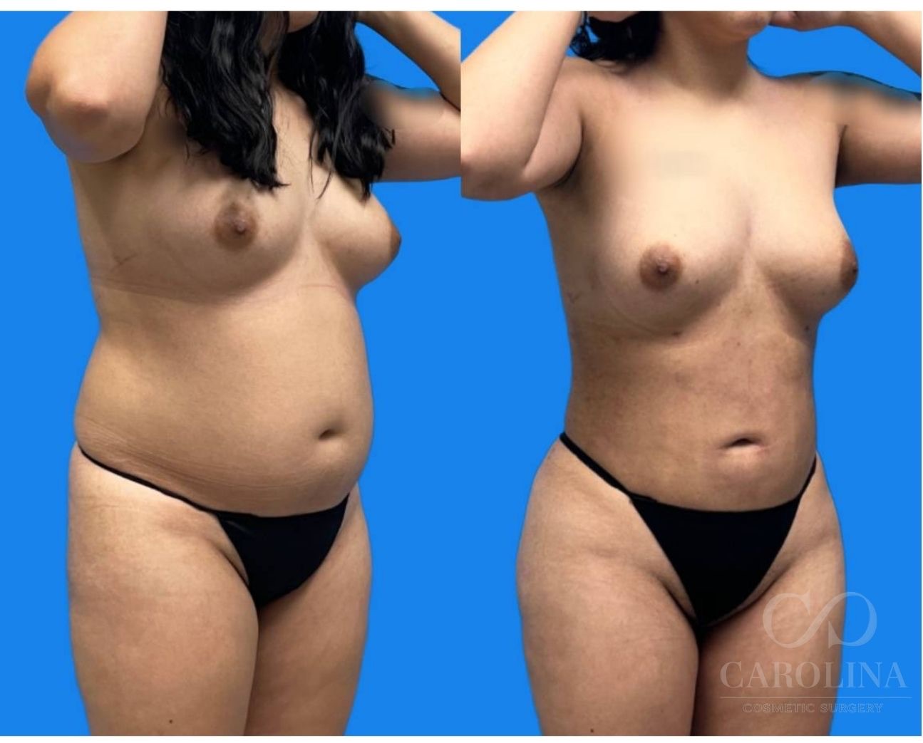 Case--5250 | Before and After Lipo 360 2