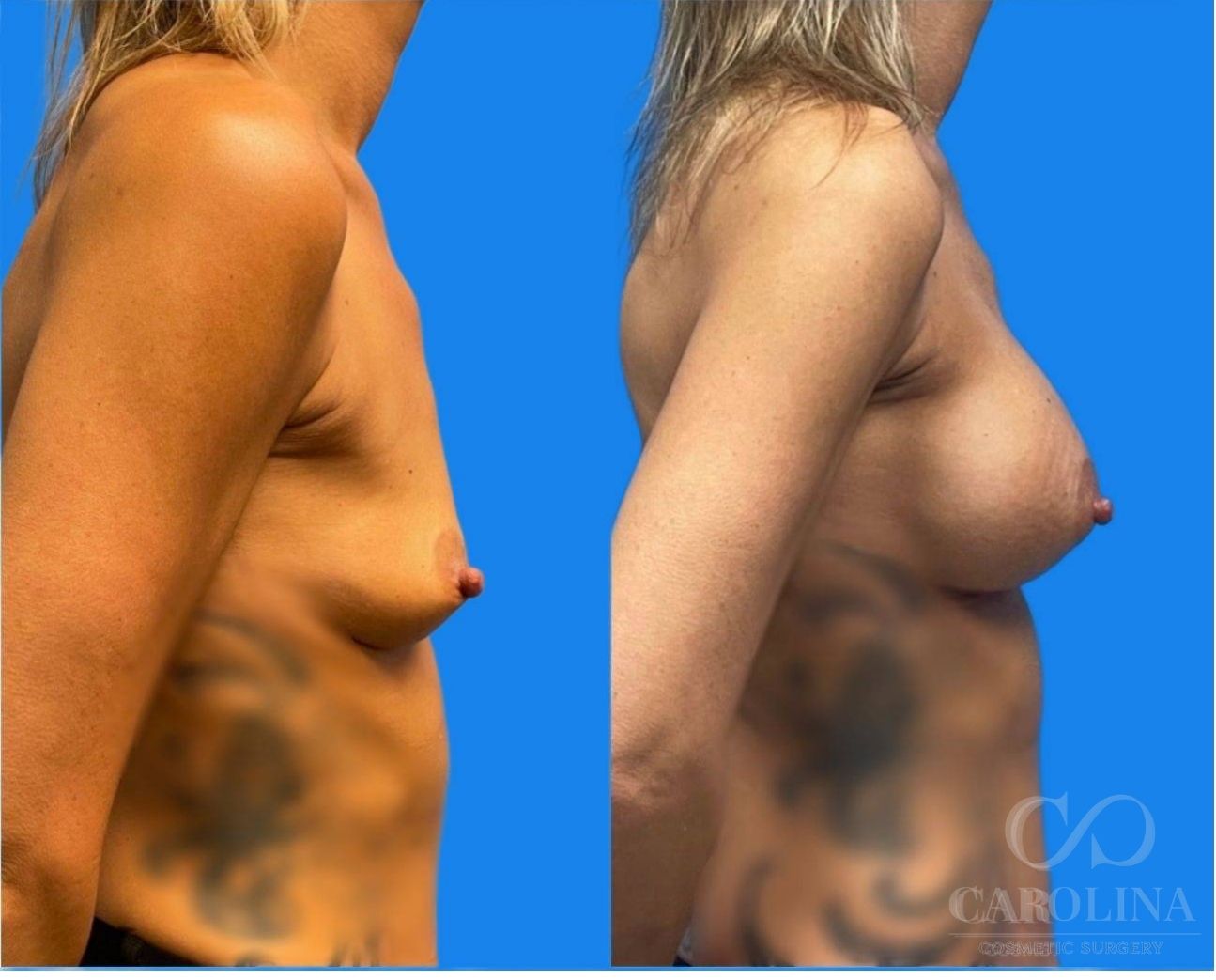 Case--4474 | Before and After Breast Augmentation 2