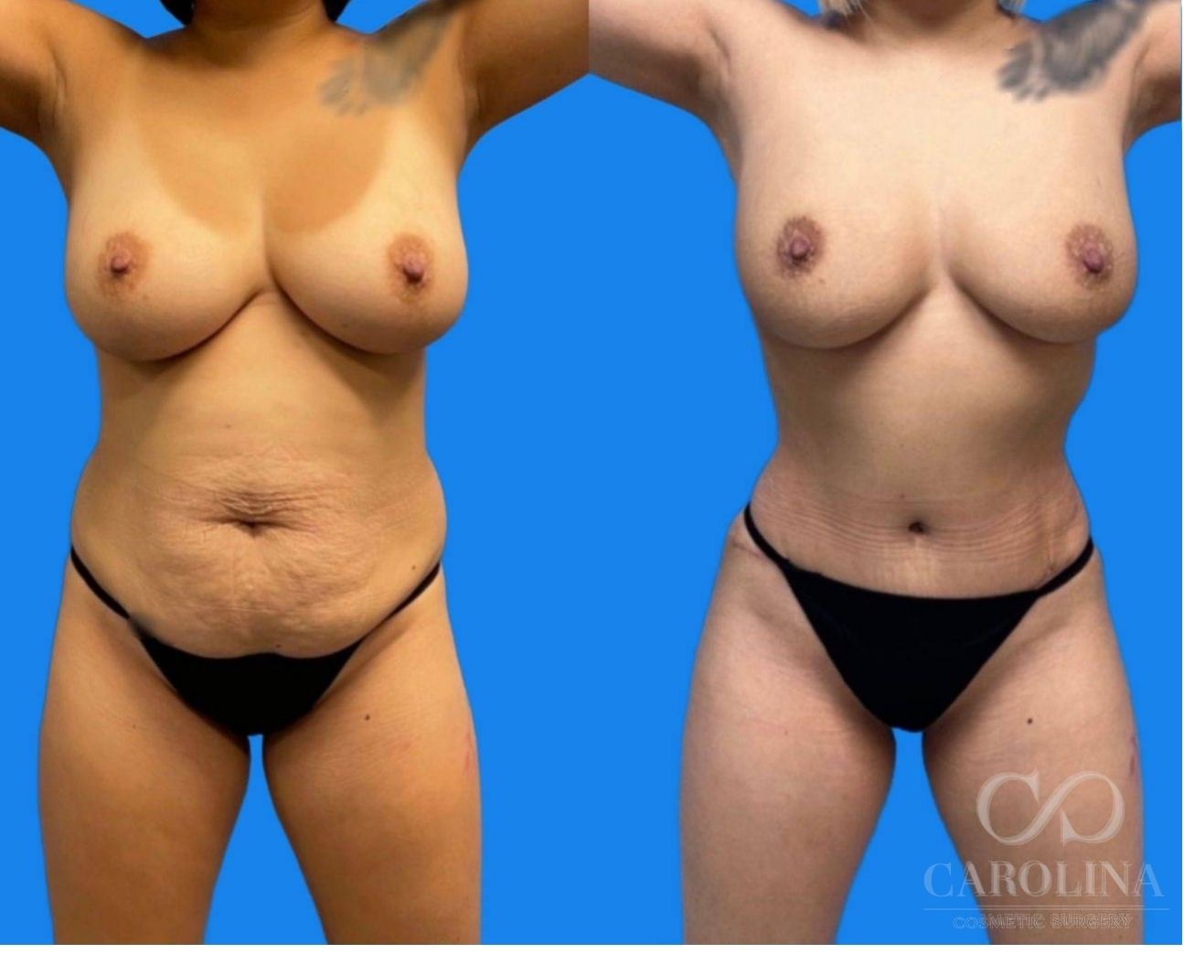 Case--6156 | Before and After Brazilian Butt Lift 2