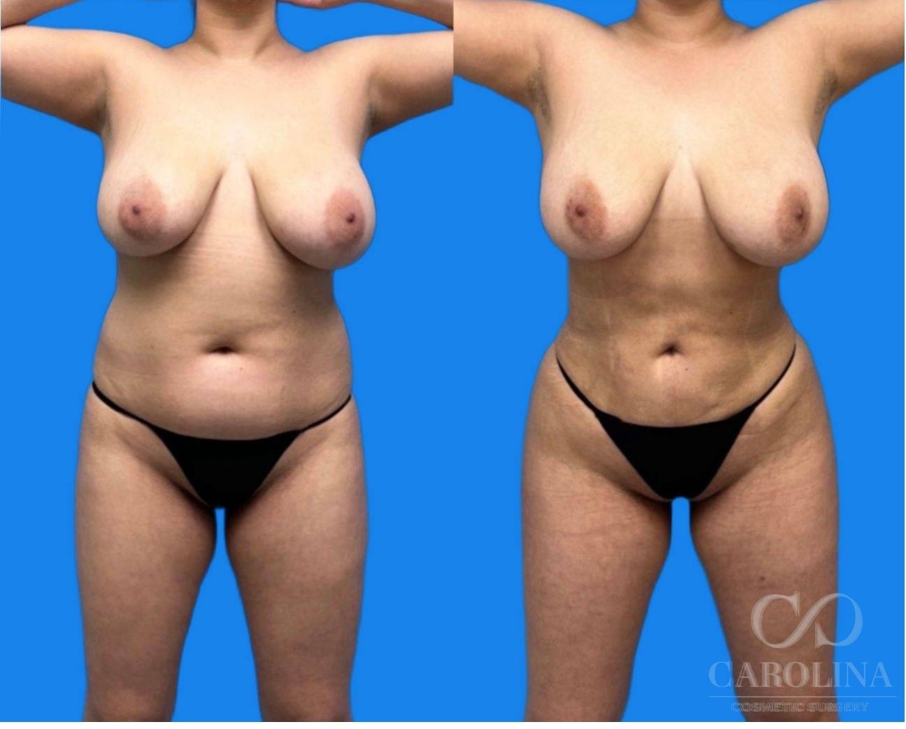 Case--2717 | Before and After Lipo 360