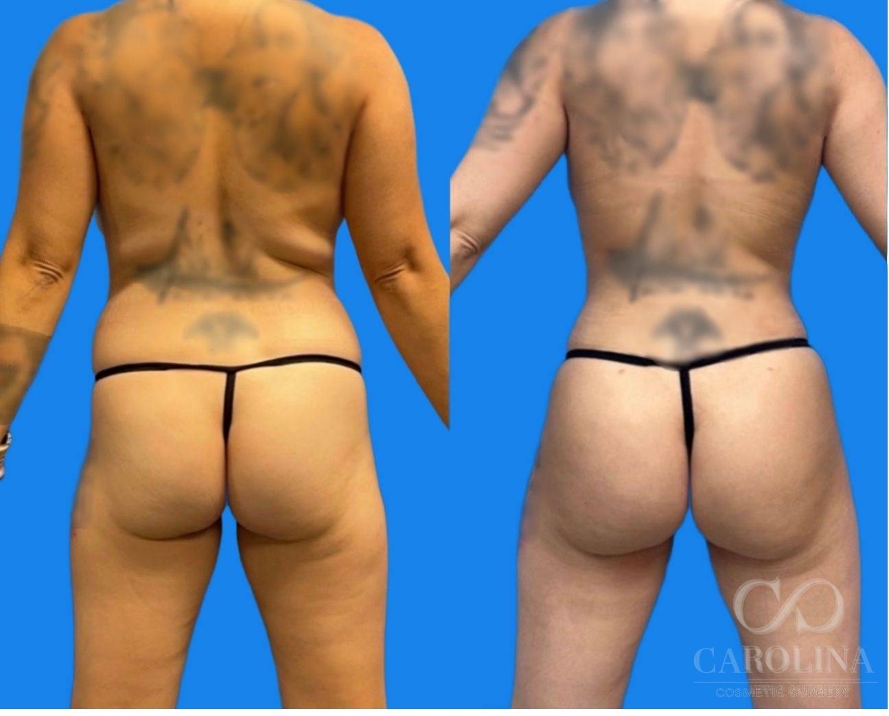Case--6156 | Before and After Brazilian Butt Lift