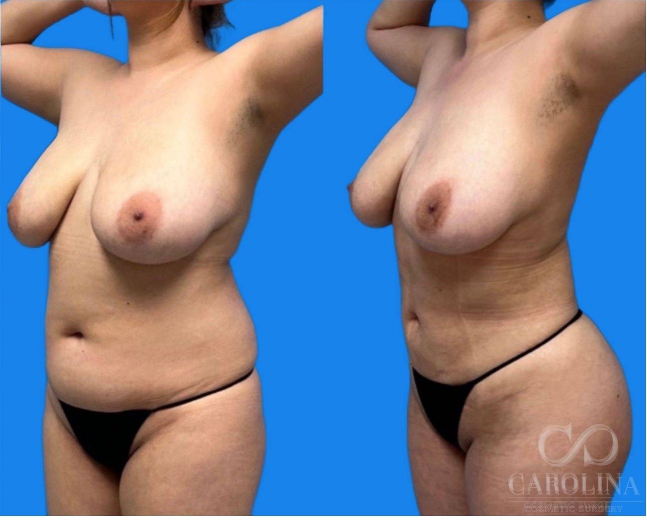 Case--1479 | Before and After Brazilian Butt Lift 3