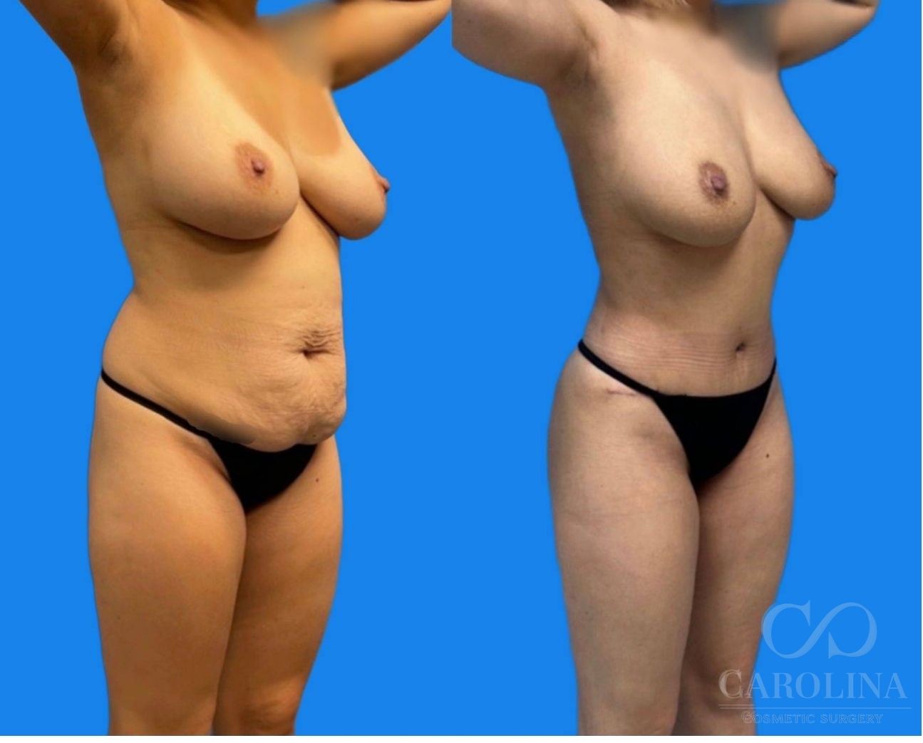 Case--6156 | Before and After Brazilian Butt Lift 3