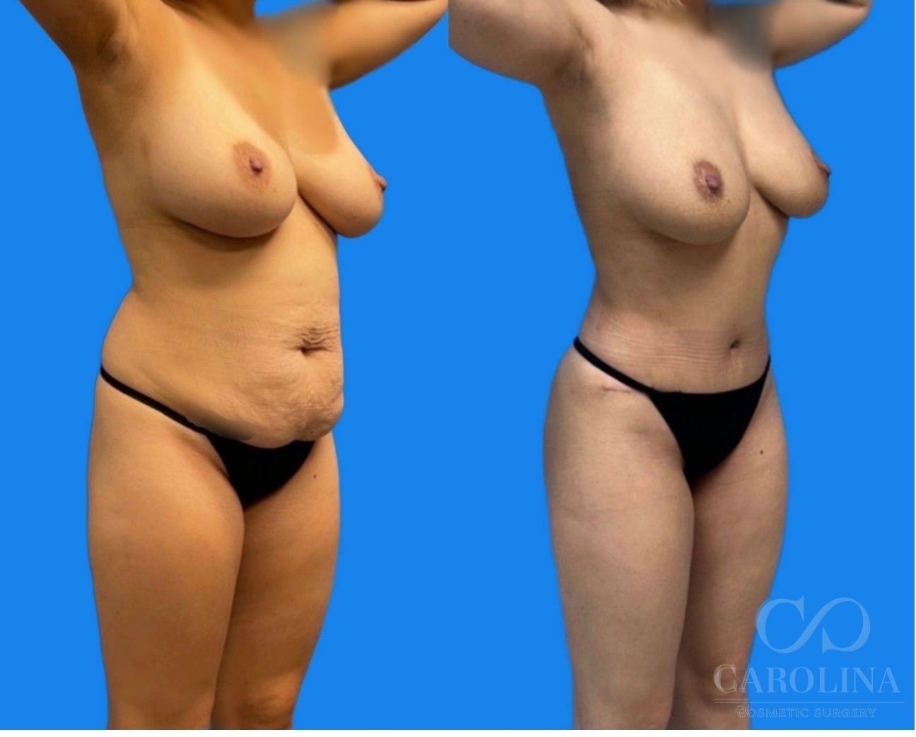 Case--6284 | Before and After Lipo 360 3
