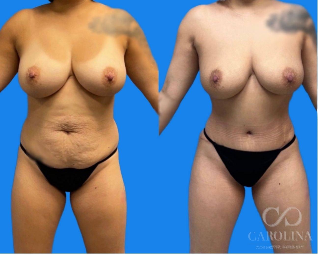 Case--6156 | Before and After Brazilian Butt Lift 4