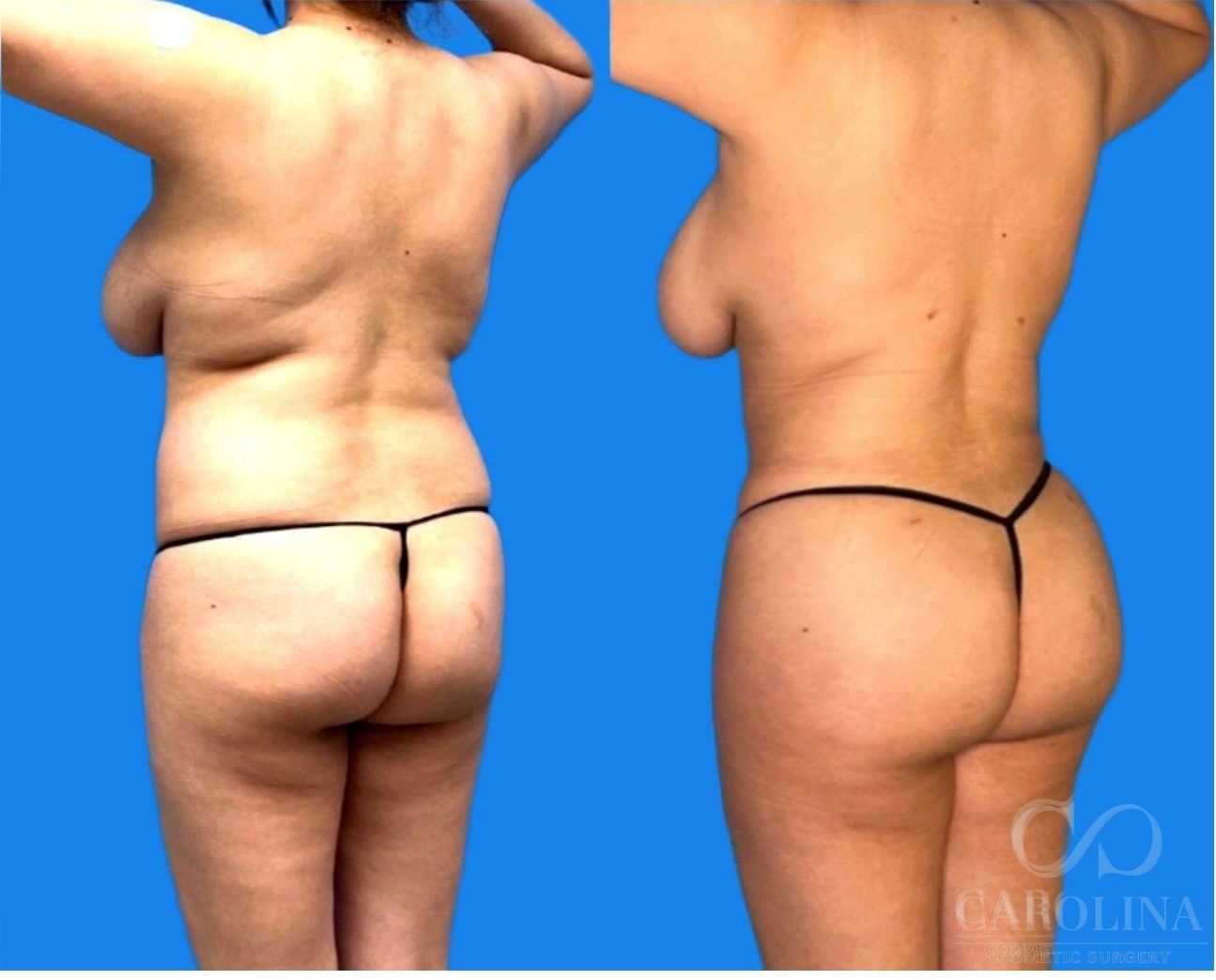 Case--1479 | Before and After Brazilian Butt Lift 2
