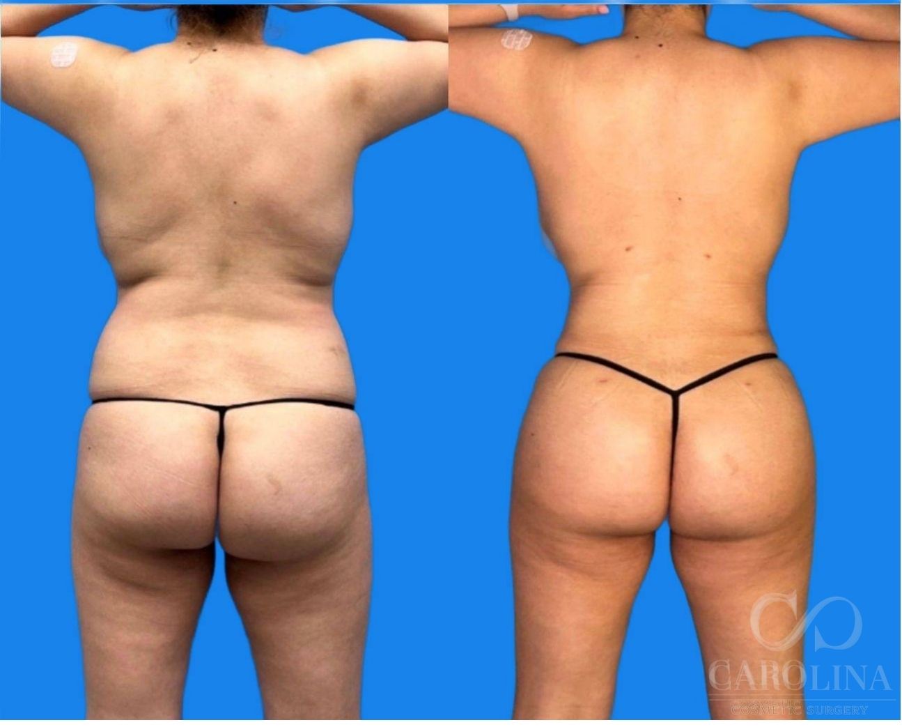 Case--1479 | Before and After Brazilian Butt Lift
