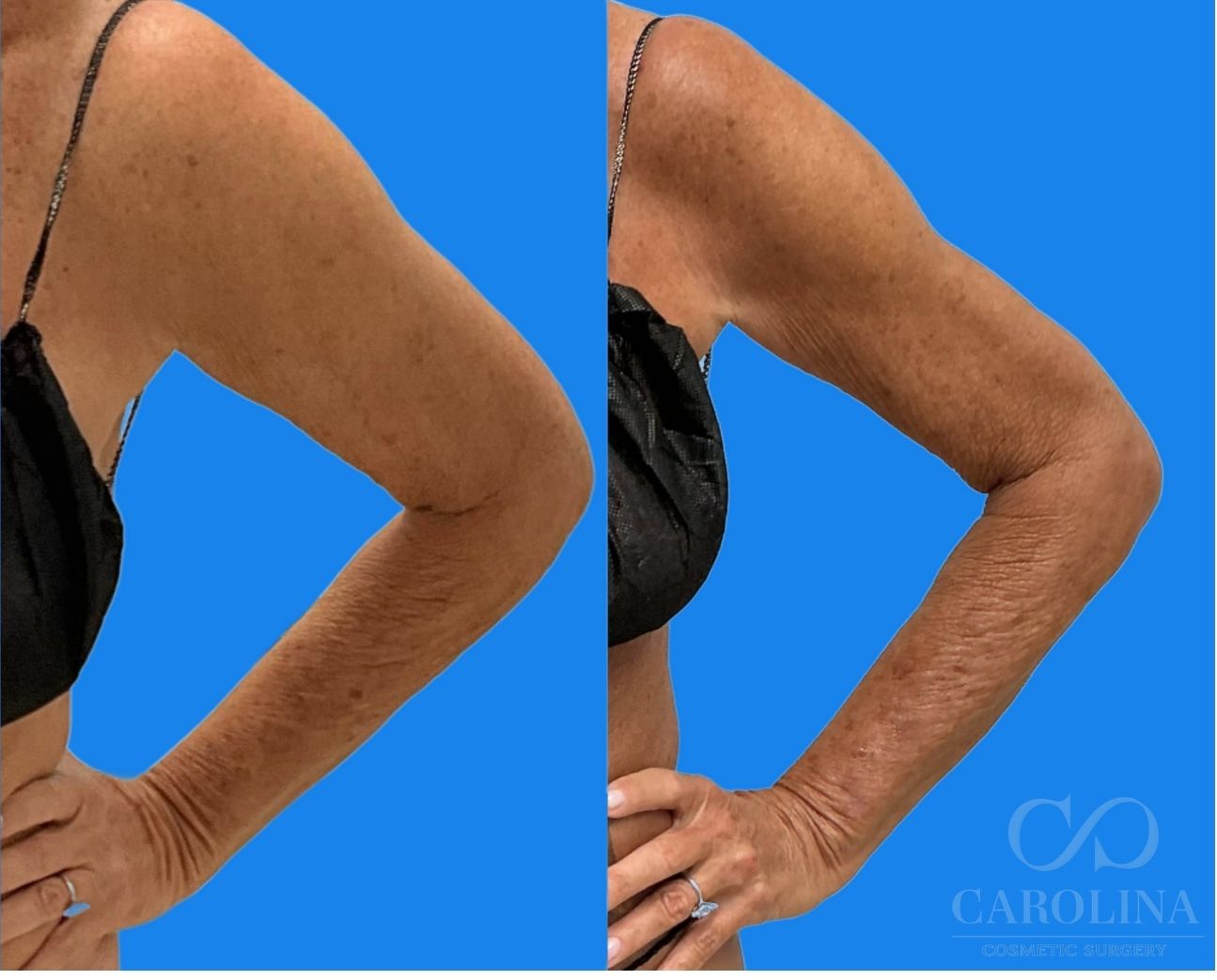 Case--9230 | Before and After Arm Sculpt 3