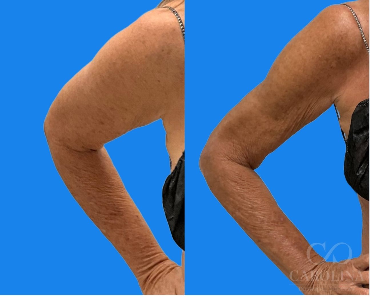 Case--9230 | Before and After Arm Sculpt 4