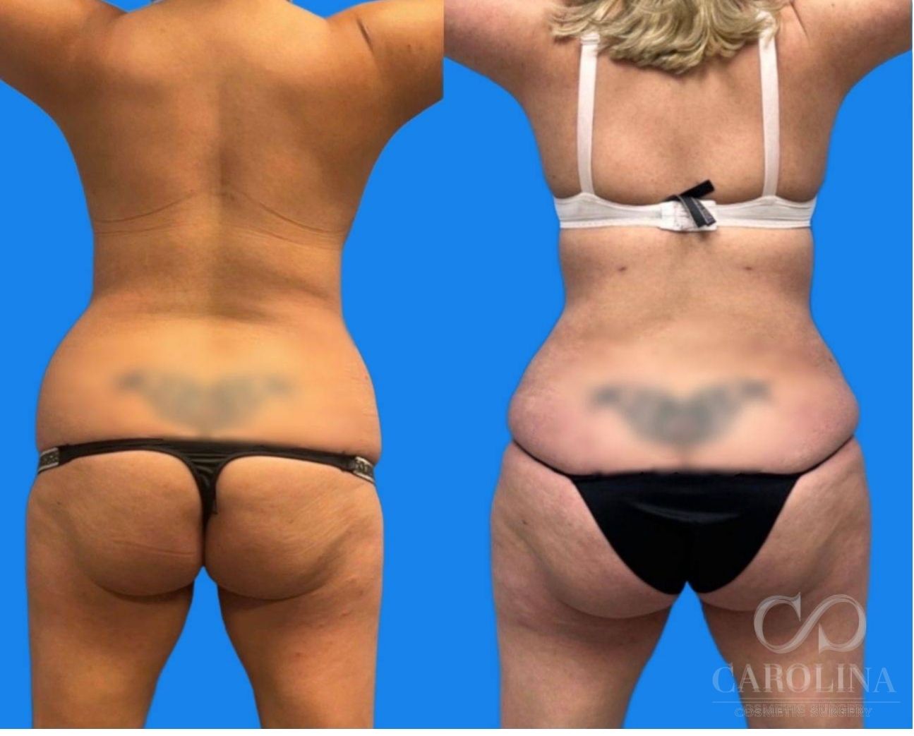 Case--6370 | Before and After Lipo 360 4