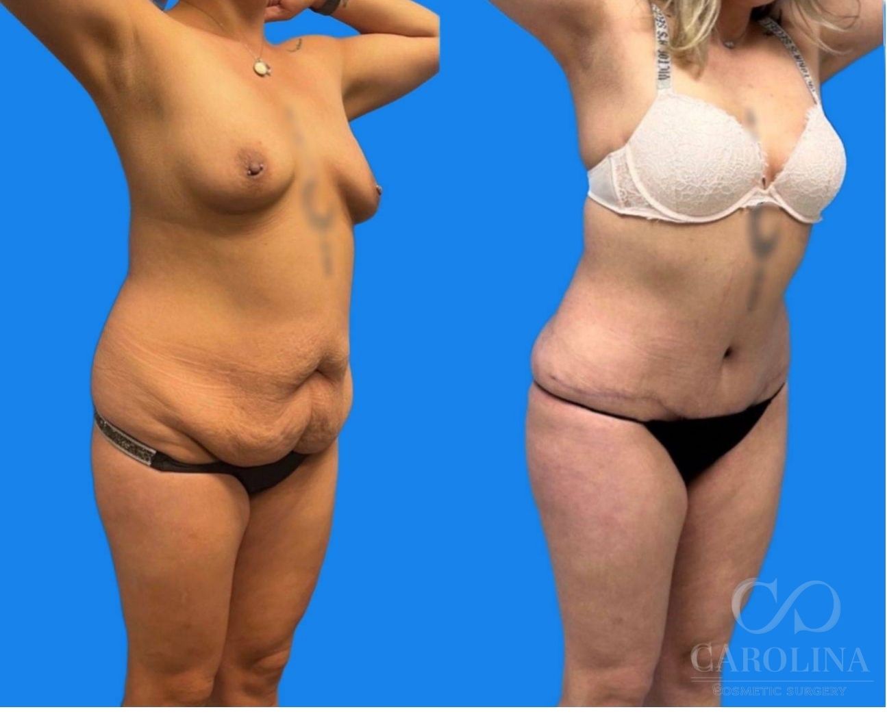 Case--6370 | Before and After Lipo 360 3