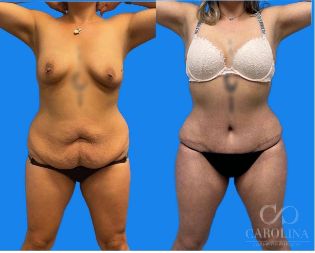 Case--6370 | Before and After Lipo 360 2