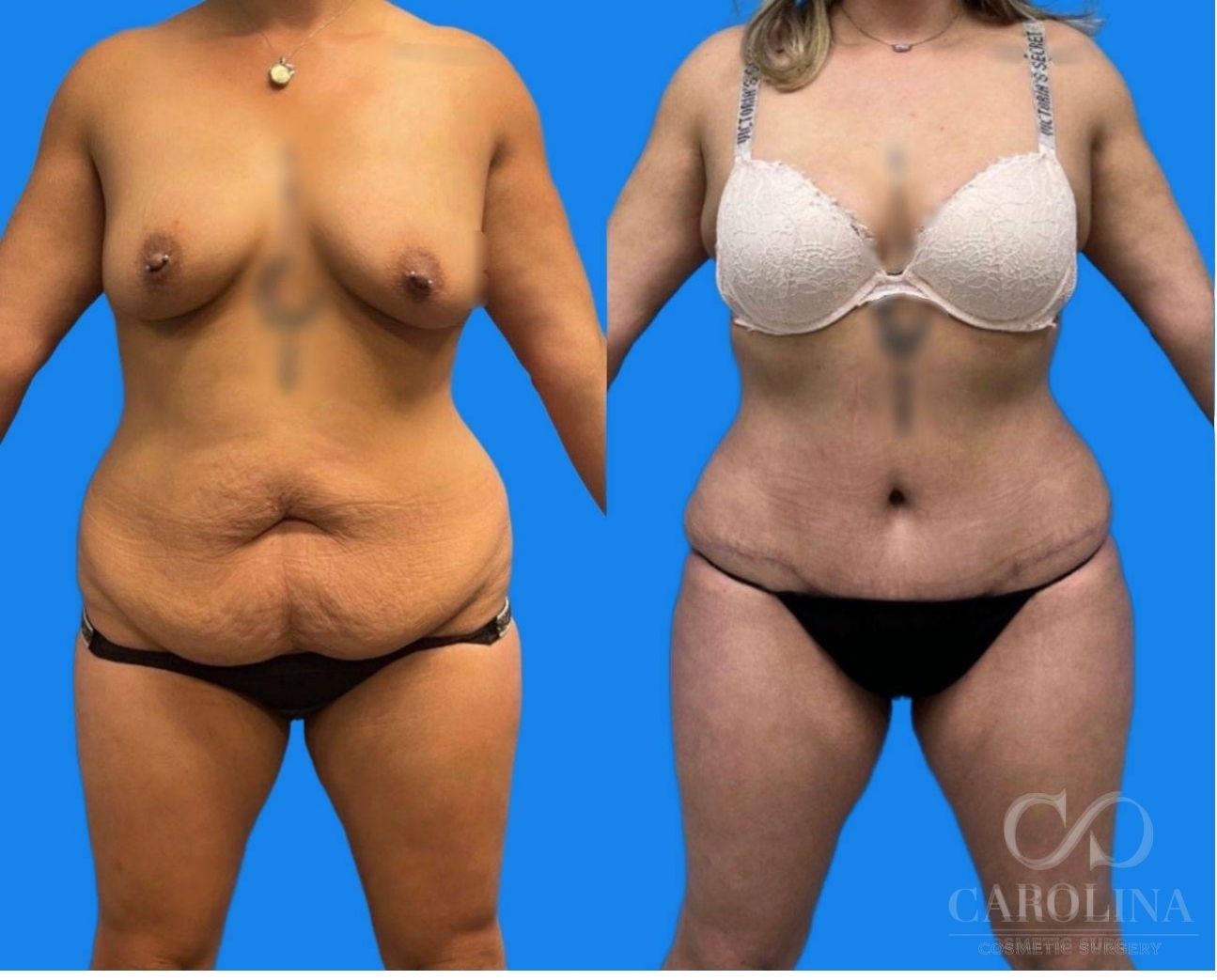Case--6370 | Before and After Lipo 360
