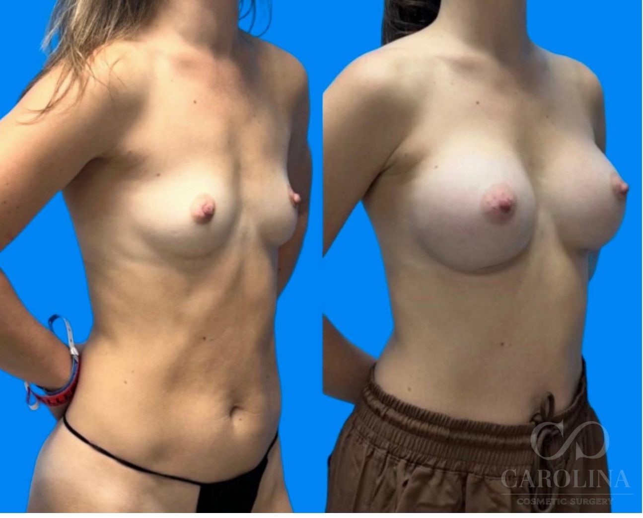 Case--4561 | Before and After Breast Augmentation 2