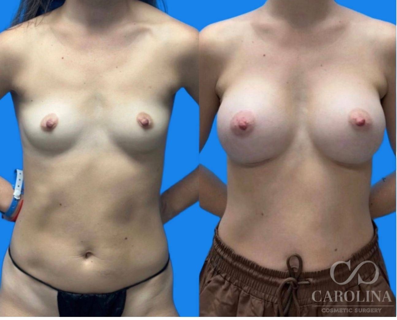 Case--4561 | Before and After Breast Augmentation