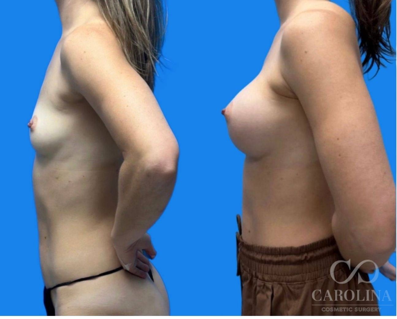 Case--4561 | Before and After Breast Augmentation 3