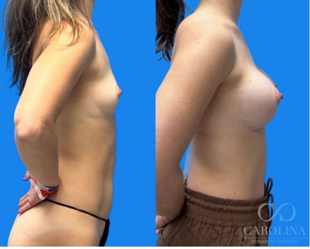 Case--4561 | Before and After Breast Augmentation 4