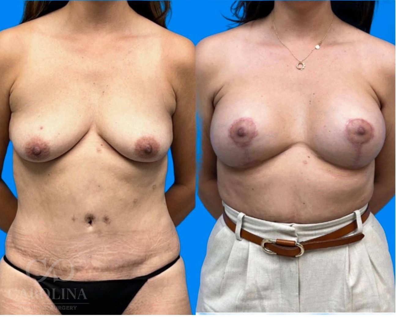 Case--8144 | Before and After Breast Augmentation