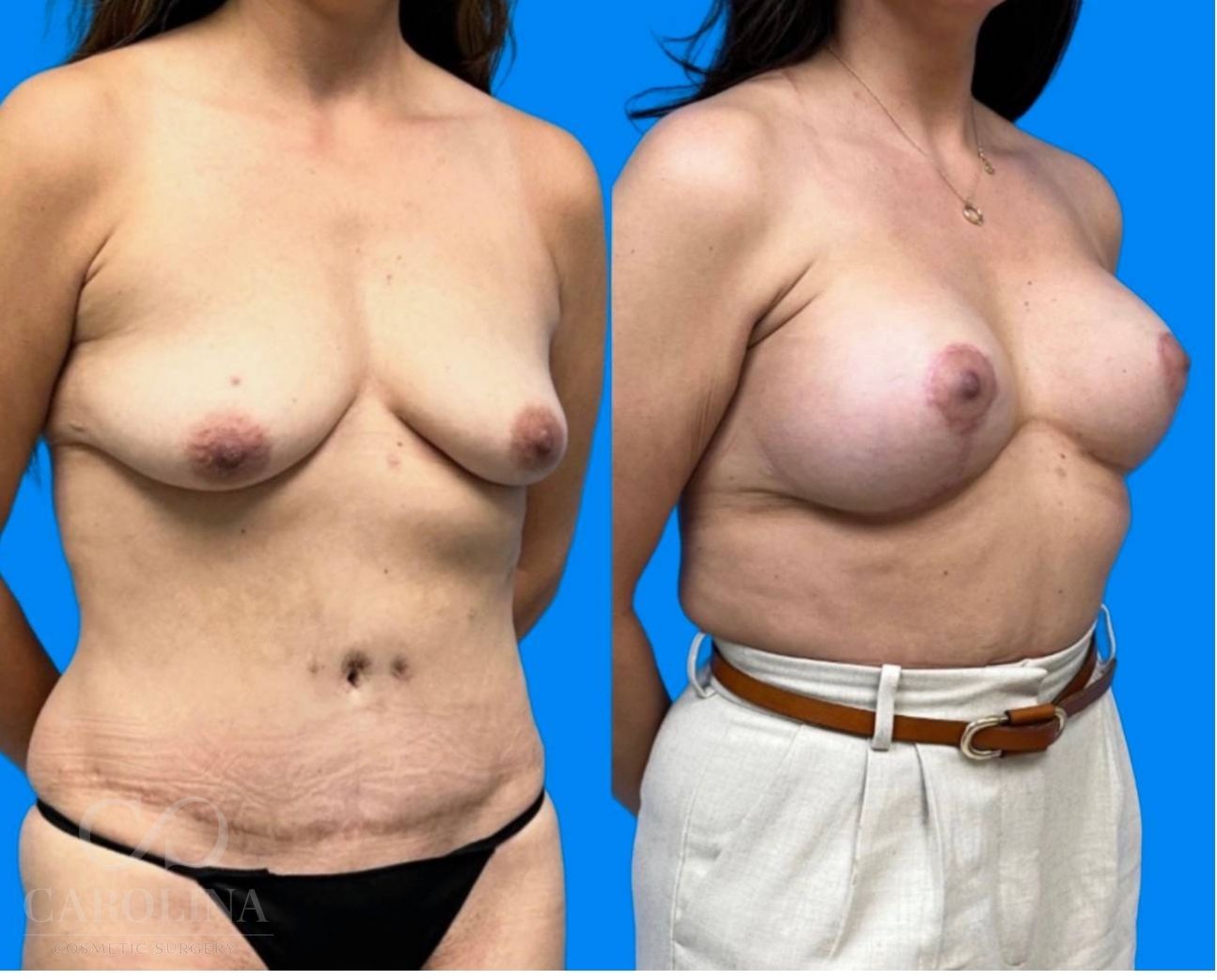 Case--8144 | Before and After Breast Augmentation 2