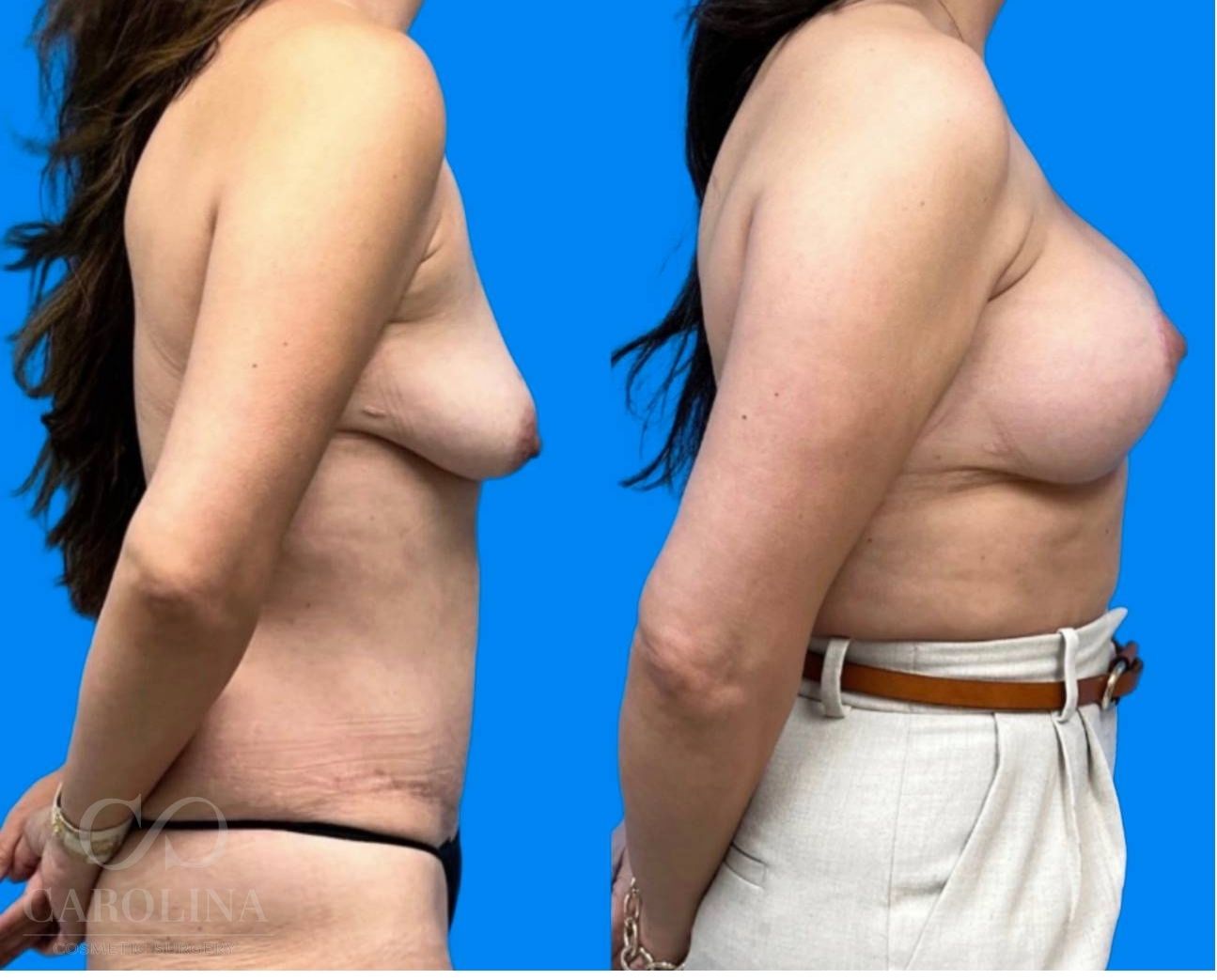 Case--8144 | Before and After Breast Augmentation 3