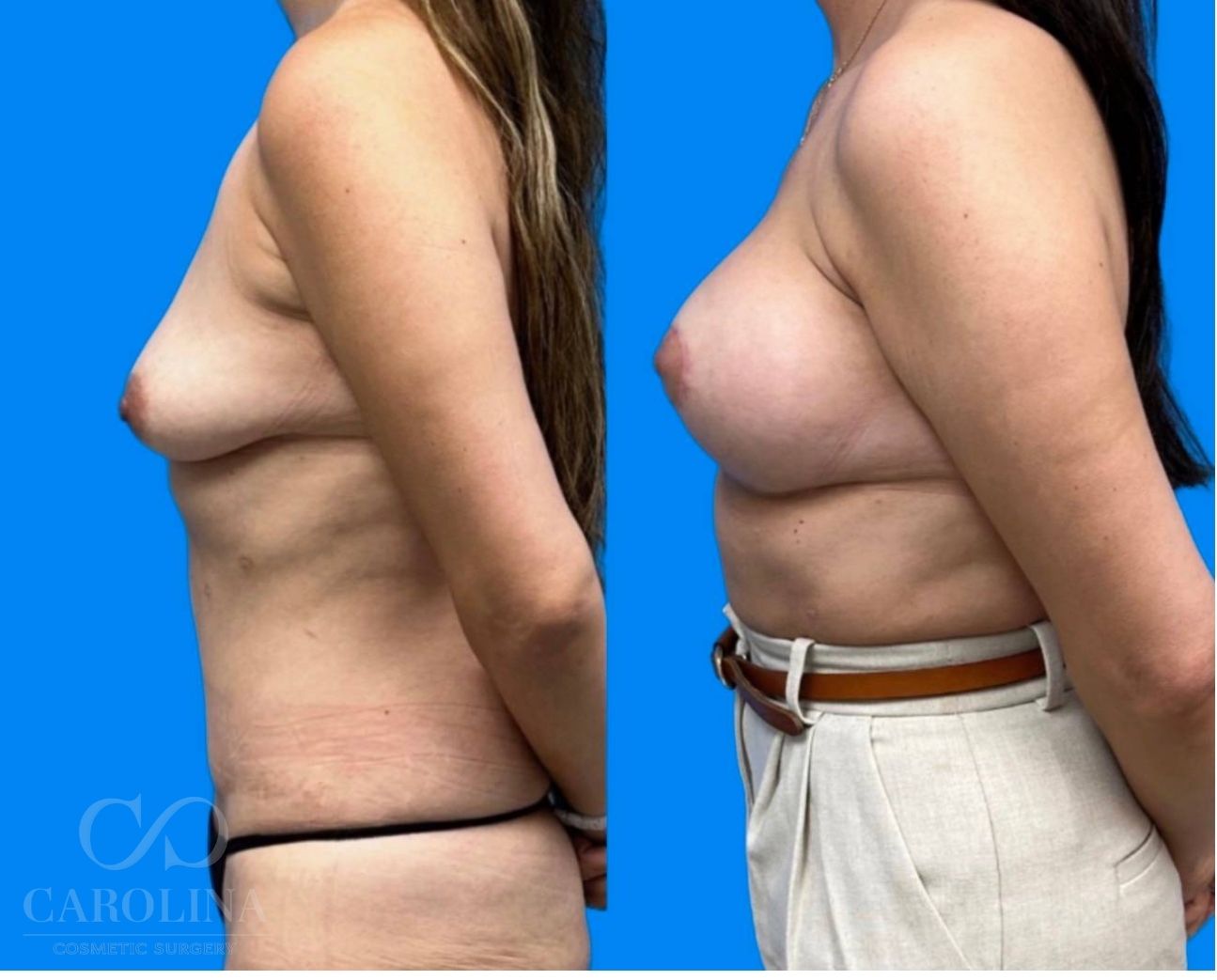 Case--8144 | Before and After Breast Augmentation 4
