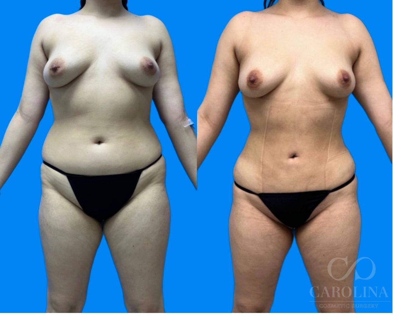 Case--1389 | Before and After Lipo 360