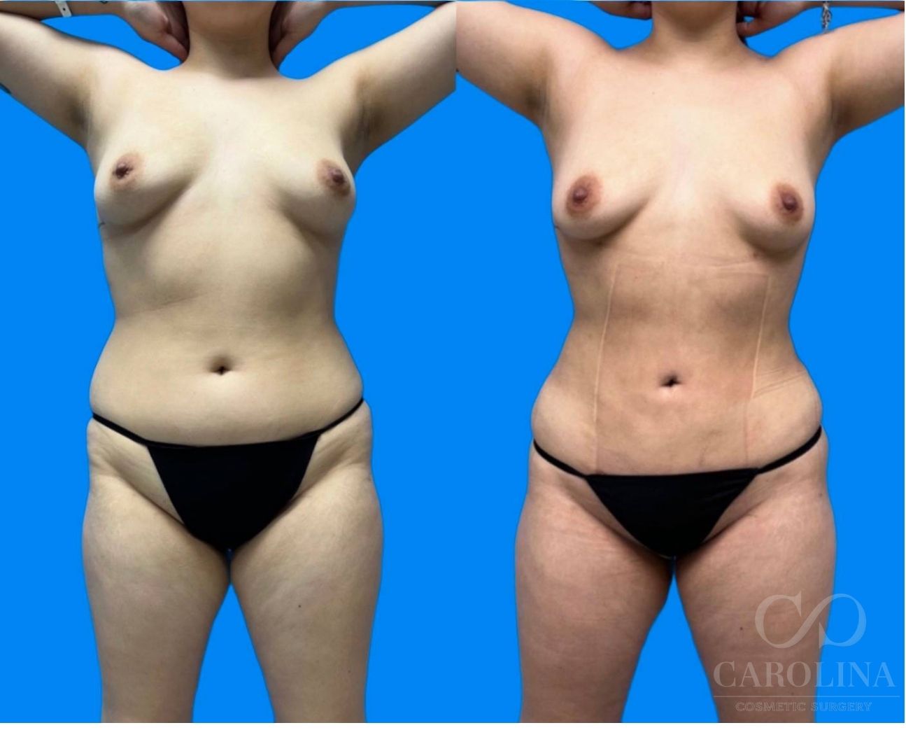 Case--1389 | Before and After Lipo 360 2