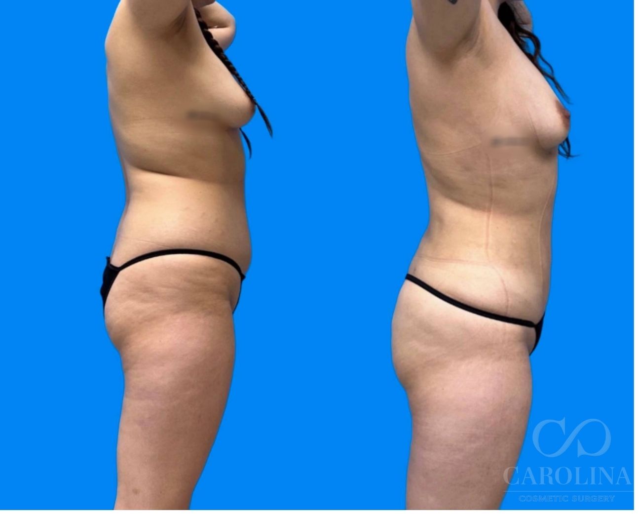 Case--1389 | Before and After Lipo 360 3