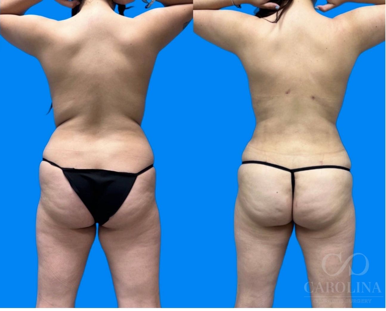 Case--1389 | Before and After Lipo 360 4