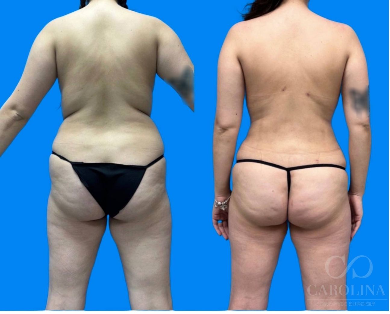 Case--1389 | Before and After Lipo 360 5