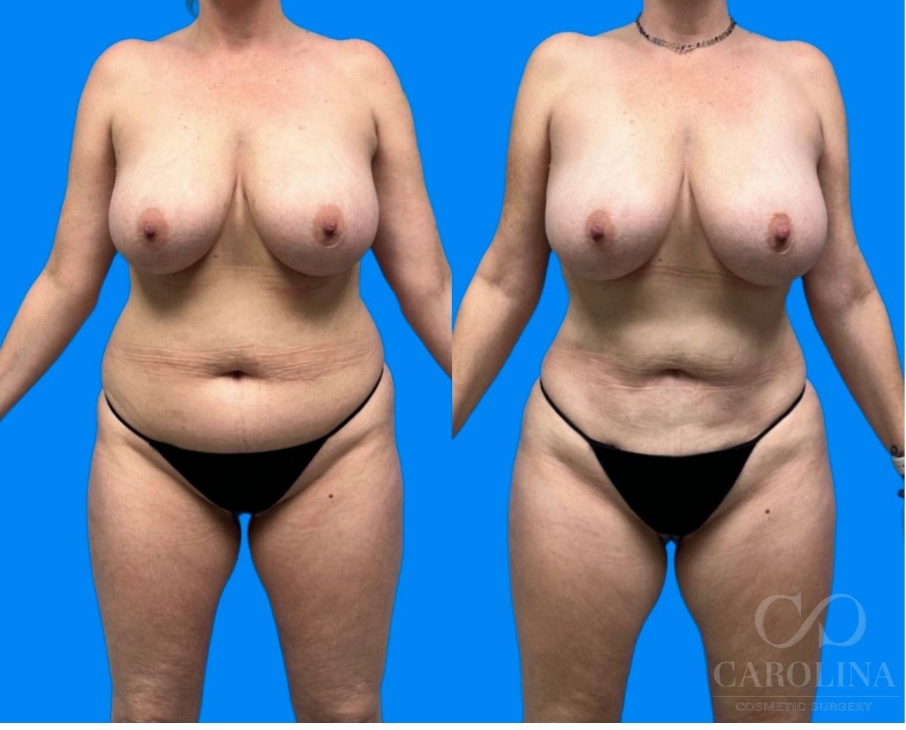 Case--6994 | Before and After Brazilian Butt Lift 5