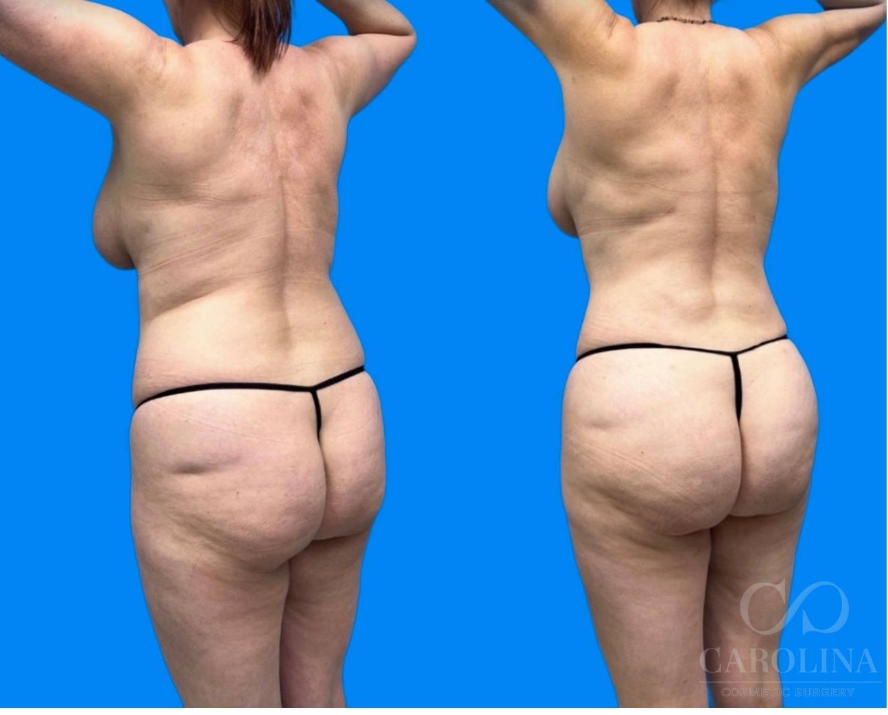 Case--1683 | Before and After Lipo 360 4