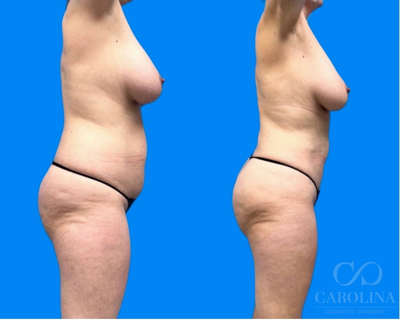 Case--1683 | Before and After Lipo 360 3