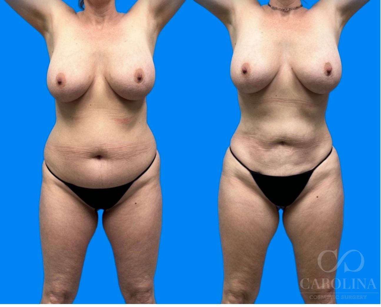 Case--1683 | Before and After Lipo 360 2
