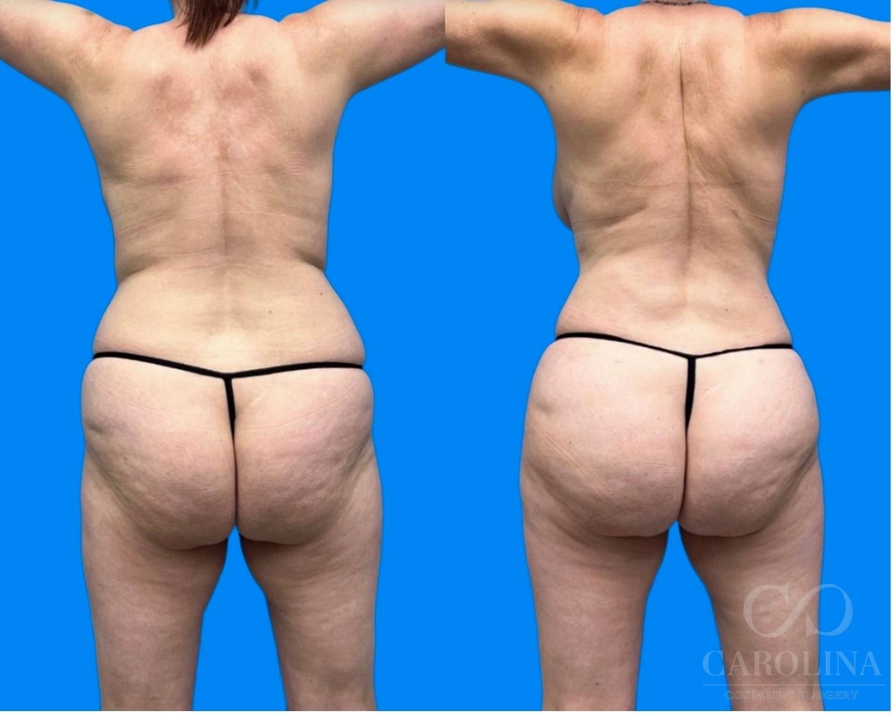Case--6994 | Before and After Brazilian Butt Lift