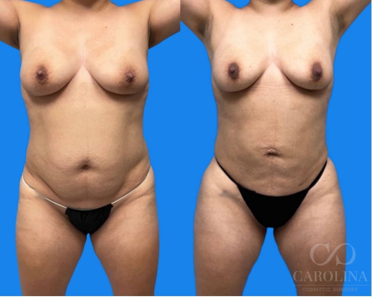 Case--3729 | Before and After Lipo 360 2