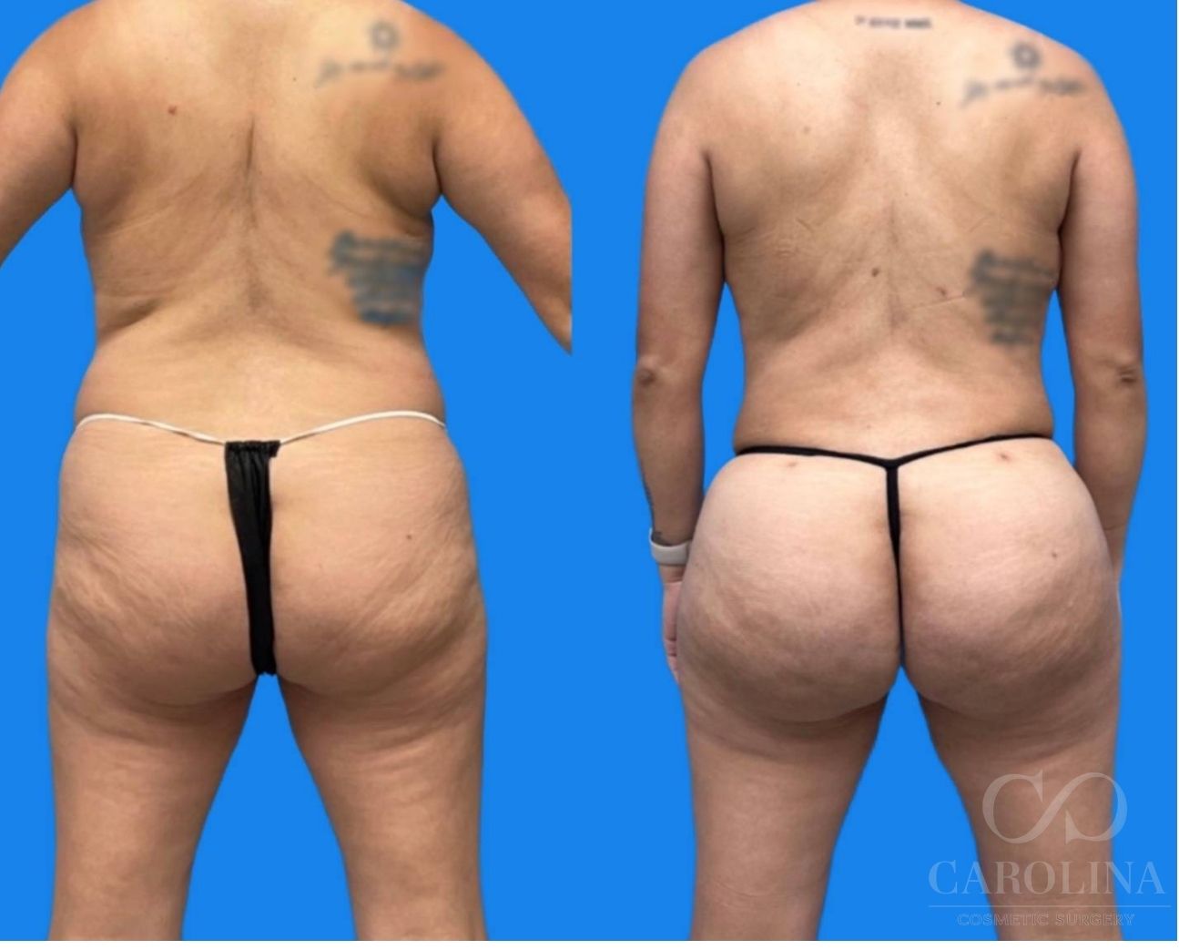 Case--9332 | Before and After Brazilian Butt Lift