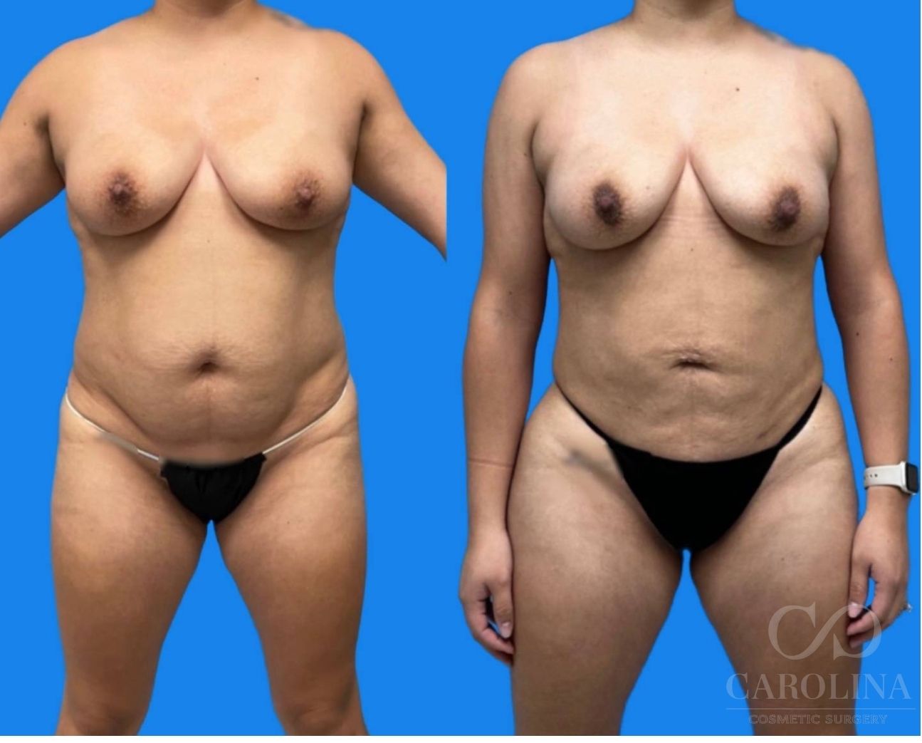 Case--9332 | Before and After Brazilian Butt Lift 4