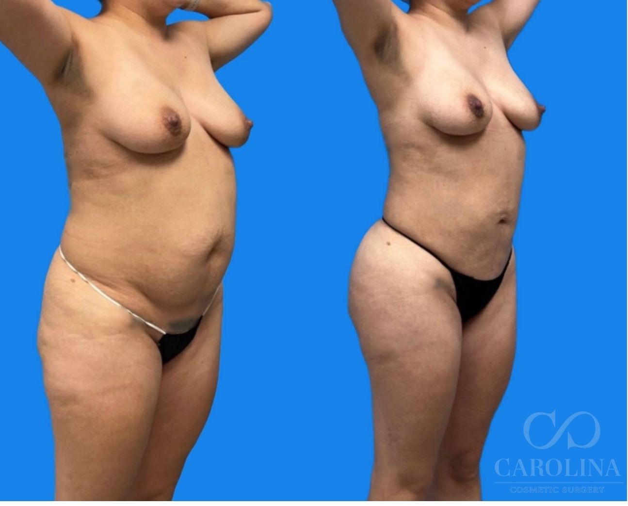 Case--3729 | Before and After Lipo 360 3